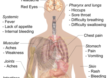 Sintomi di Ebola. Autore: Mikael Häggström