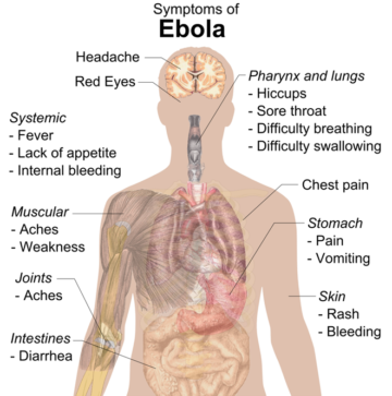 Sintomi di Ebola. Autore: Mikael Häggström