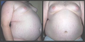 Vista frontale e laterale di un grande obeso. Immagine caricata su wiki da Doc James