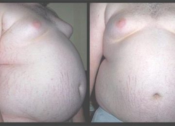 Vista frontale e laterale di un grande obeso. Immagine caricata su wiki da Doc James