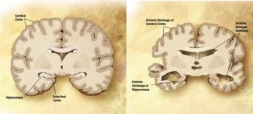 Confronto tra un cervello sano (a sinistra) e un cervello di una persona affetta da Malattia di Alzheimer (a destra). Pubblico dominio. Fonte https://it.wikipedia.org/wiki/Malattia_di_Alzheimer