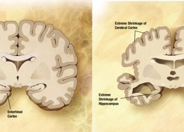 Confronto tra un cervello sano (a sinistra) e un cervello di una persona affetta da Malattia di Alzheimer (a destra). Pubblico dominio. Fonte https://it.wikipedia.org/wiki/Malattia_di_Alzheimer