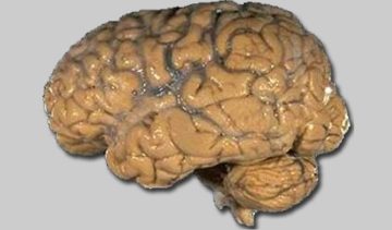 Un cervello umano. Pubblico dominio, https://commons.wikimedia.org/w/index.php?curid=2448409