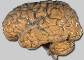 Un cervello umano. Pubblico dominio, https://commons.wikimedia.org/w/index.php?curid=2448409